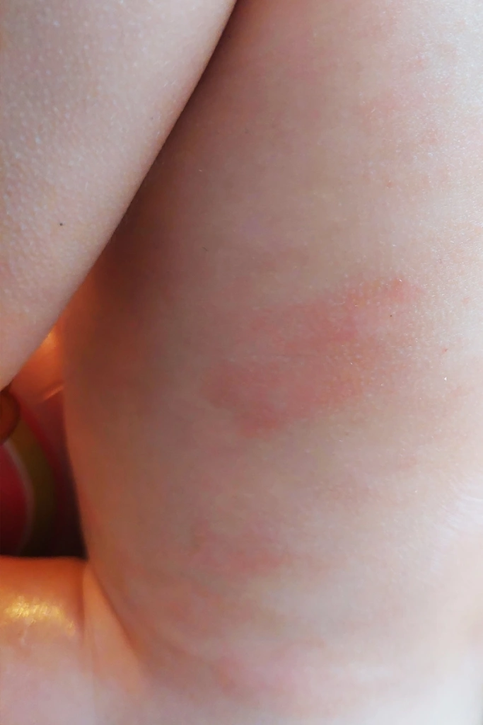 Izbruh suhe, luskaste in srbeče kože na hrbtu enoletnega otroka. Tu je že potekalo iskanje naravne rešitve za pomiritev atopijskega dermatitisa.