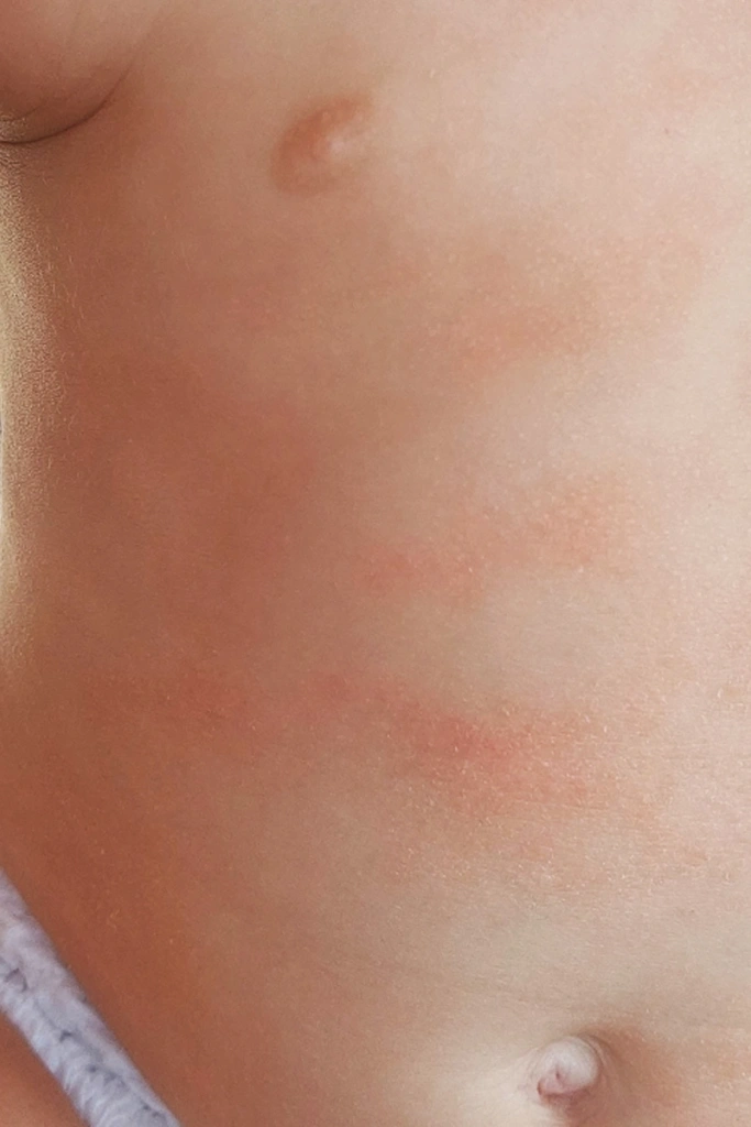 Rdeči, vneti fleki in suha koža na trebuščku enoletnika. Kako varno in učinkovito negovati otroško kožo z dermatitisom?