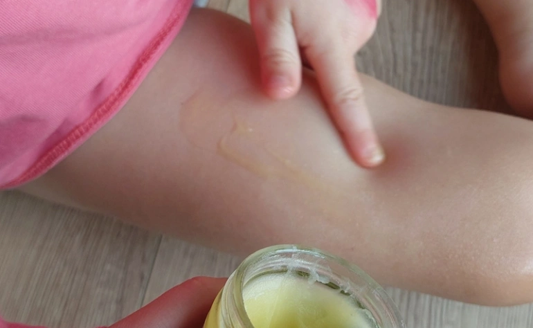 Atopijski dermatitis pri otrocih